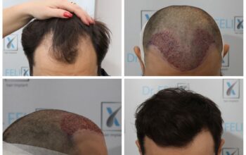 Cât costă un implant de păr? Te ajută reprezentanții Dr. Felix Hair Implant cu informațiile necesare